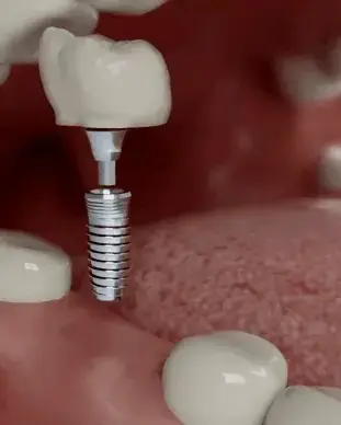 Implant-1-ezgif.com-crop (1)