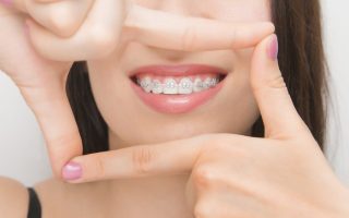 brackets-ortodontici